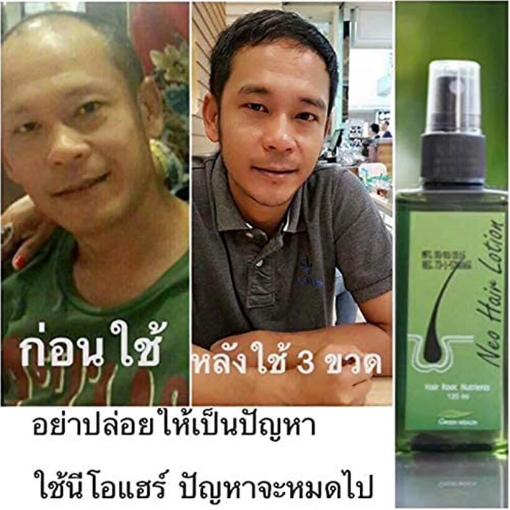 Hair Regrowth Lotion Haircare Hair Loss Oil Baldness Hair thinning 120ml Spray