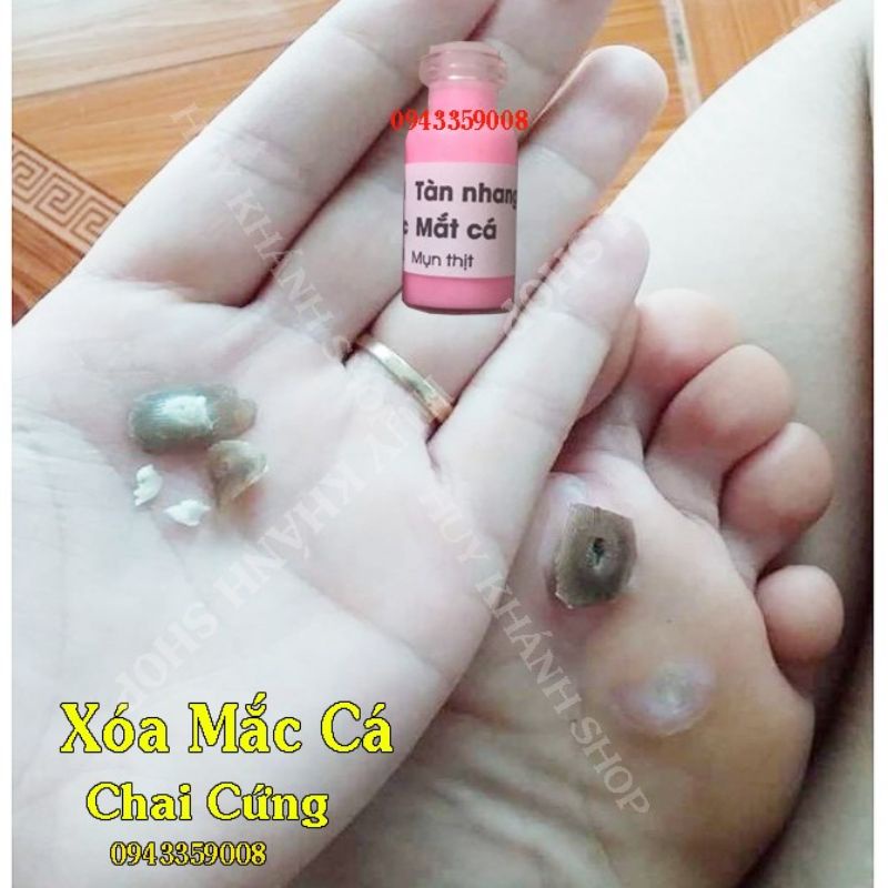 Tẩy Nốt Ruồi Mụn,Mụt Cóc,Tàn Nhang Mụn Thịt,Mắc Cá