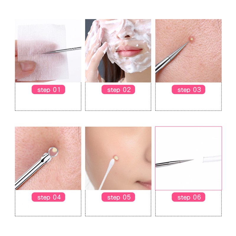 Sỉ - Que cây nặn mụn 2 đầu thép không gỉ, nặn_mụn an toàn tiện lợi - Hanayuki Beauty Clinic