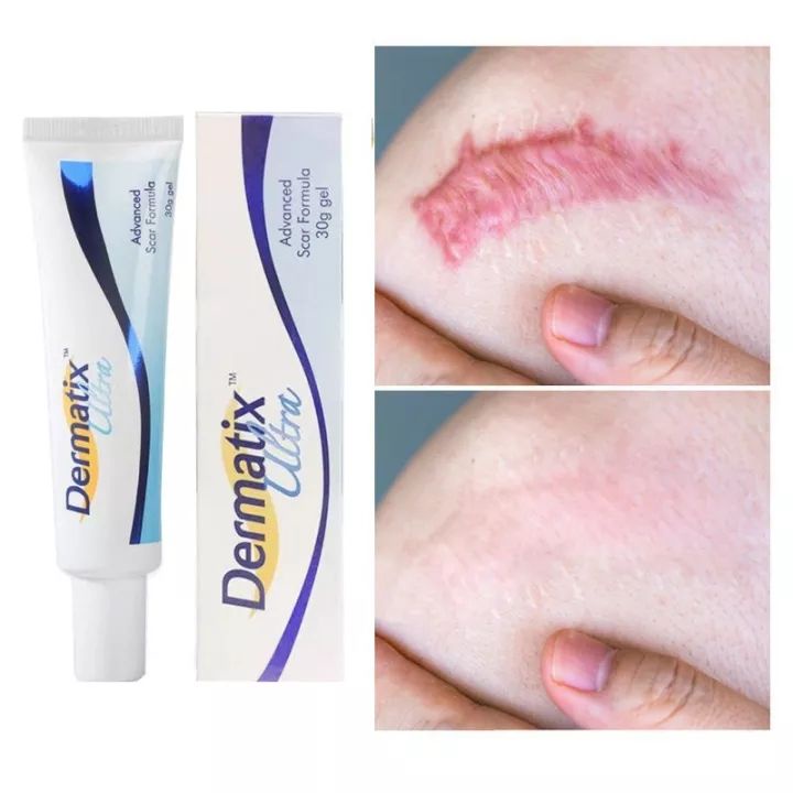 【Từ tp Hồ Chí Minh gửi hàng】kem xóa sẹo Dermatix Ultra 15g, Làm mờ sẹo chuyên sâu, an toàn, tiện lợi, dễ dàng sử dụng làm phẳng, mềm sẹo lồi, sẹo thâm, sẹo rỗ, sẹo phì đại, thấm nhanh, không cần massage, không nhờn dính - Bảo vệ khỏi tia UVA và UVB