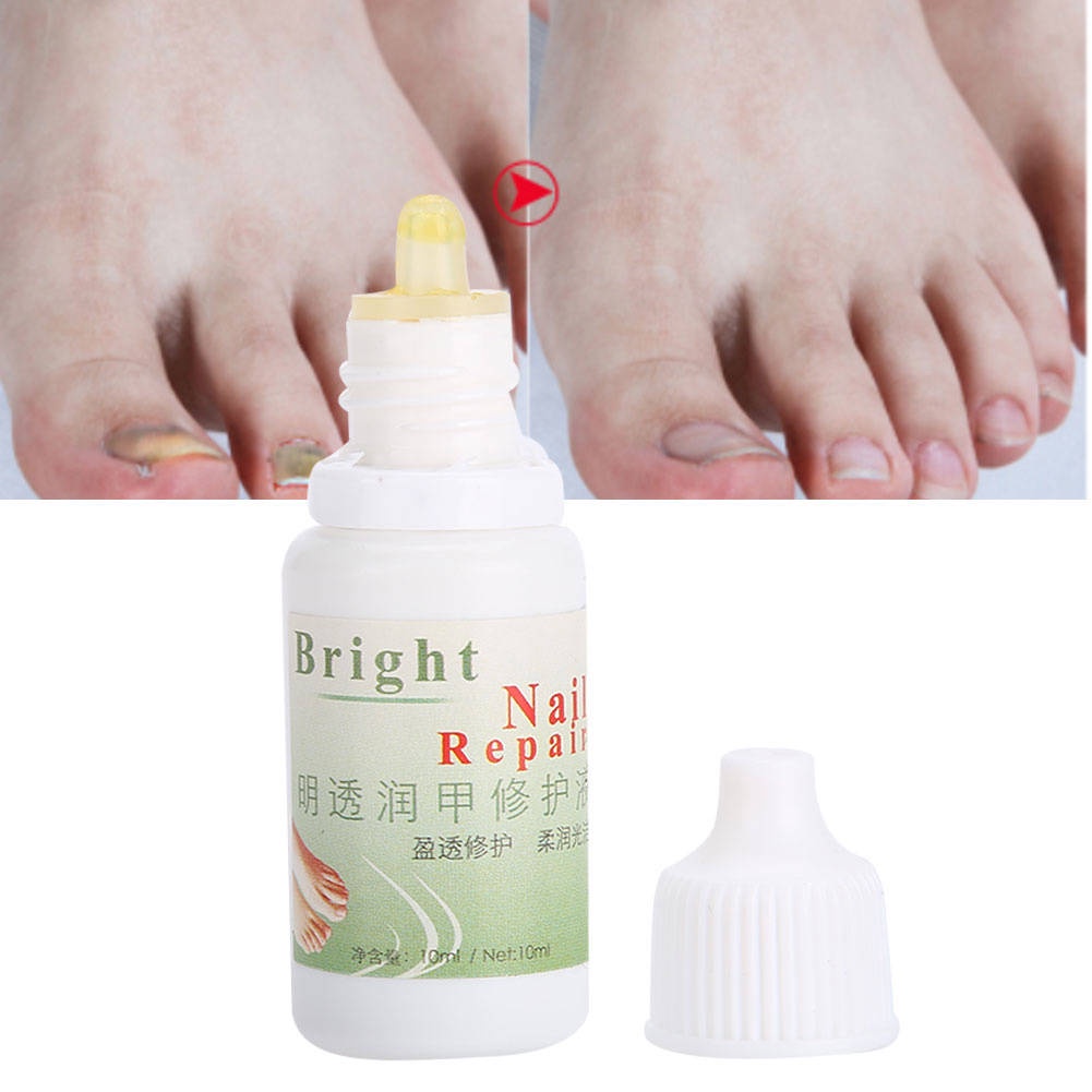 Tinh chất loại bỏ nấm móng tay tự nhiên dạng lỏng chăm sóc tiện lợi 10ml