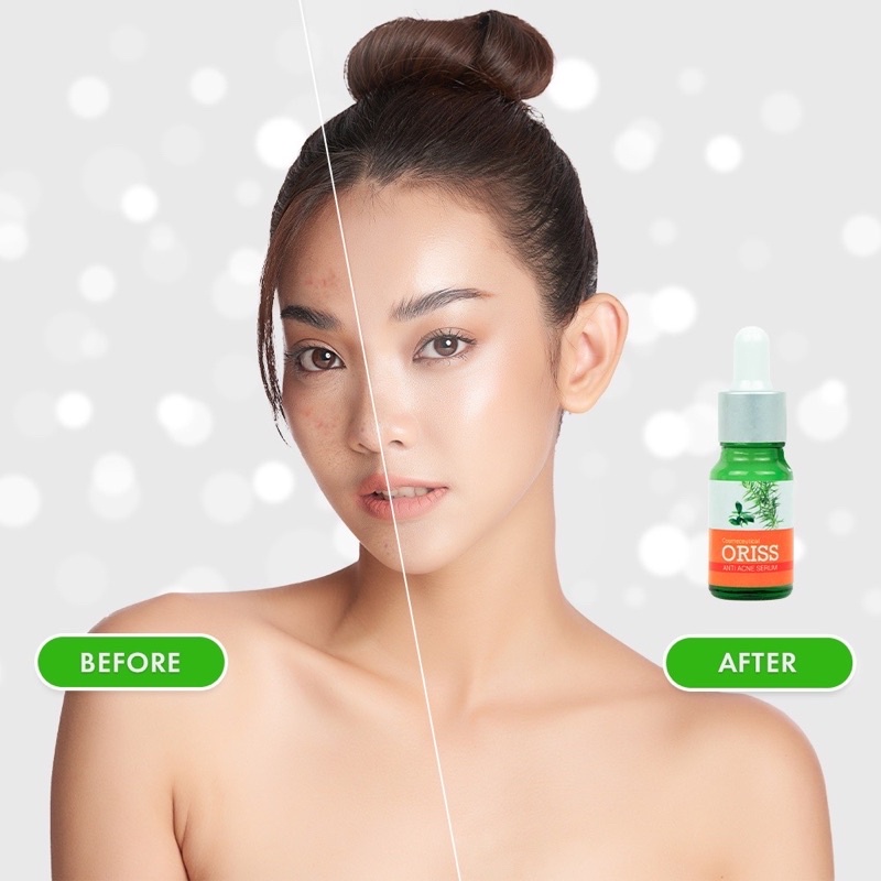 Serum Hỗ Trợ Giảm Mụn Và Phòng Ngừa Mụn Dưỡng Trắng Da Oriss 10ml