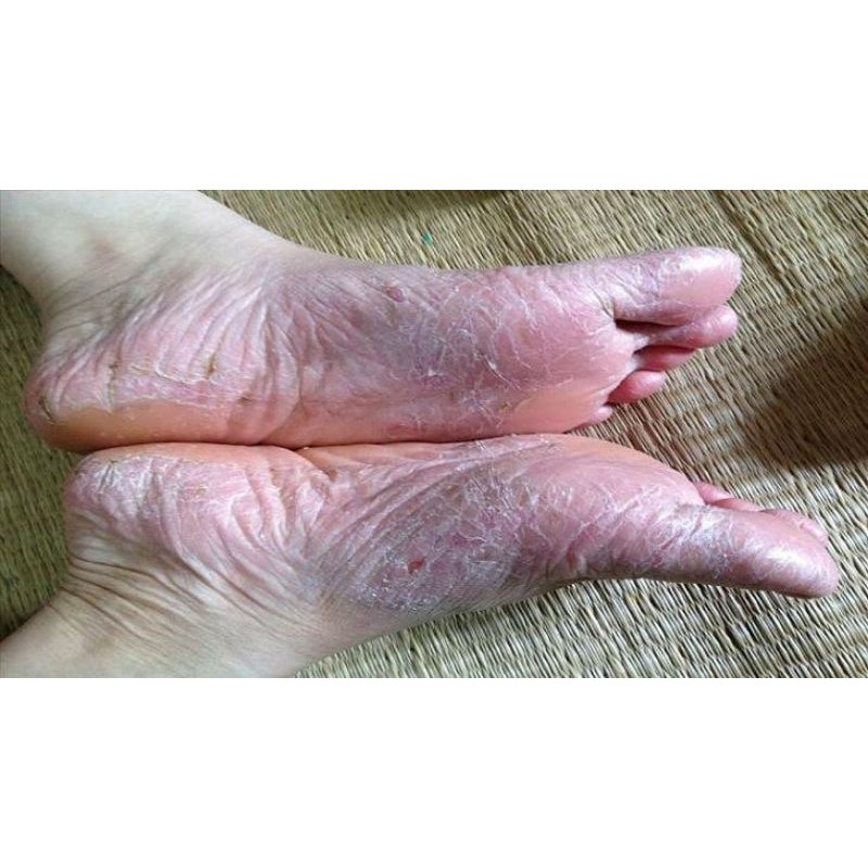 Kem bôi tổ đỉa, vẩy nến, nấm chân tay, hắc lào, nứt nẻ, á sừng, nấm da.. , viêm da cơ địa