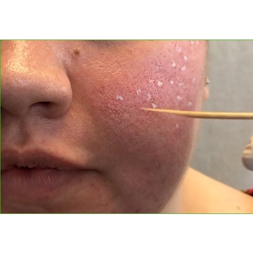 Peel chấm TCA 50%,75%, 80% Làm Đầy Sẹo Rỗ Sẹo Lõm Splendora | TRICHLOROACETIC ACID - Tặng kèm bao tay y tế