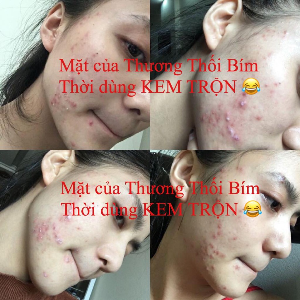 Tái Tạo Mụn- Rỗ - Lỗ Chân Lông To Thảo Dược Hoàng Cung