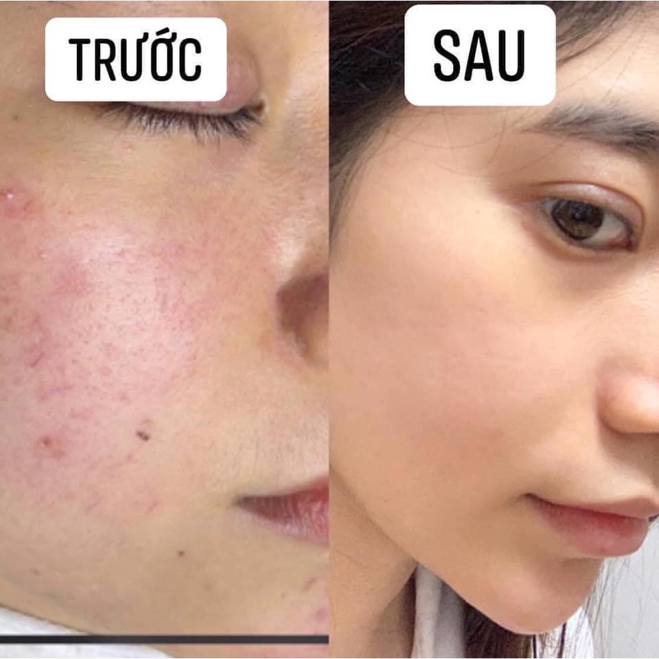 Serum Cho Da Dầu Mụn Phục Hồi Cấp Ẩm Chống Lão Hóa Hydrating B5 Mediphar 30ml