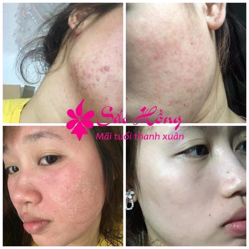 Tinh Chất Sắc Hồng Ngừa Mụn Nám