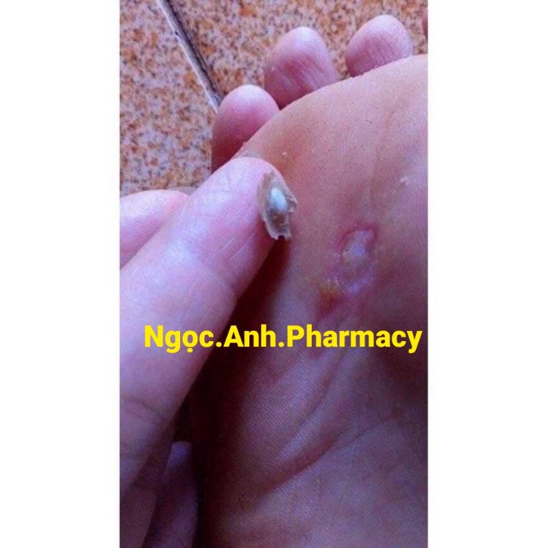 Dung dịch A.c.i.d trichloraceti.c 80% loại bỏ mụn cơm, cóc;mắt cá chân vết chai sần