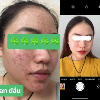 [CHÍNH HÃNG] Kem Giảm Mụn, Mờ Thâm ACNEDERM 20g