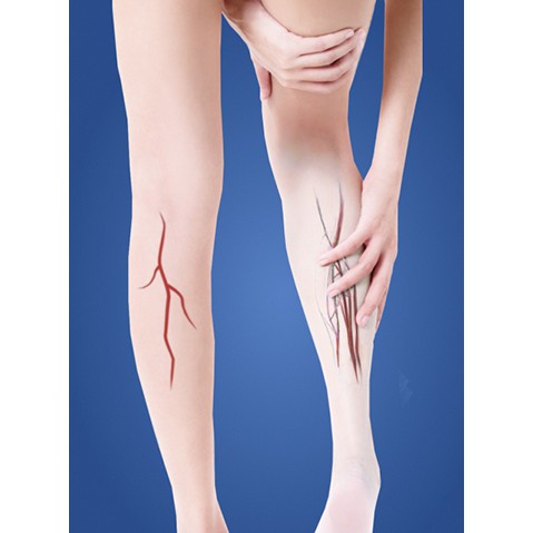 Tất y khoa suy giãn tĩnh mạch Altiform⚡Nhập khẩu Mỹ⚡Vớ bắp chân giúp cải thiện suy giãn tĩnh mạch