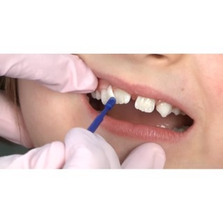 Gel bôi vecni flour chống sâu răng V-Varnish Hàn Quốc- Hàng chính hãng Vericom