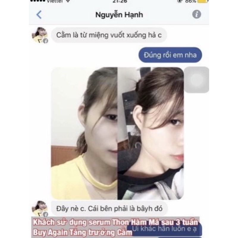 Tinh chất thu xương hàm má Miracle - Pháp, hiệu quả chỉ sau 14 ngày (10ml)