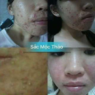 Sắc mộc thảo