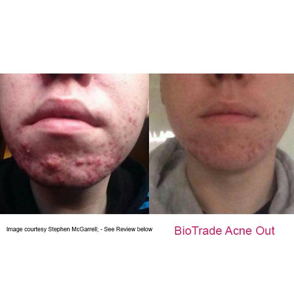 Chấm Mụn Biotrade Acne Out Active Lotion