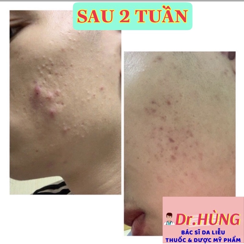 ✅ Giảm Mụn MOTBI Cream 70g, Giảm Mụn Trứng Cá, Mụn Ẩn , Mụn Đầu Đen