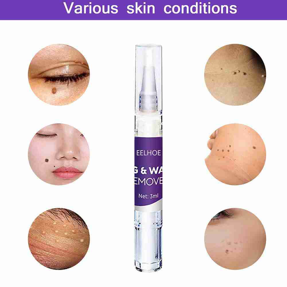 [Hàng mới về] Dung dịch loại bỏ mụn cóc / nốt ruồi A8T2