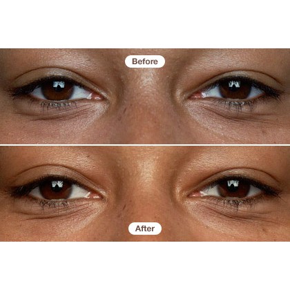 Kem mắt RoC Retinol Correxion Eye Cream