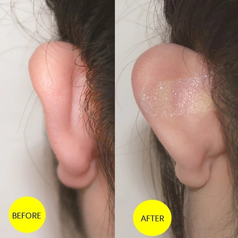 [Hot Promos] Miếng Dán Chỉnh Sửa Lỗ Tai / Chỉnh Sửa Tai Đứng / Chỉnh Sửa Lỗ Tai Hình Chữ V