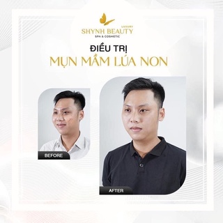 [ Hỏa Tốc ]MẦM LÚA NON MỤN 50ml❤️ - Shynh Beauty