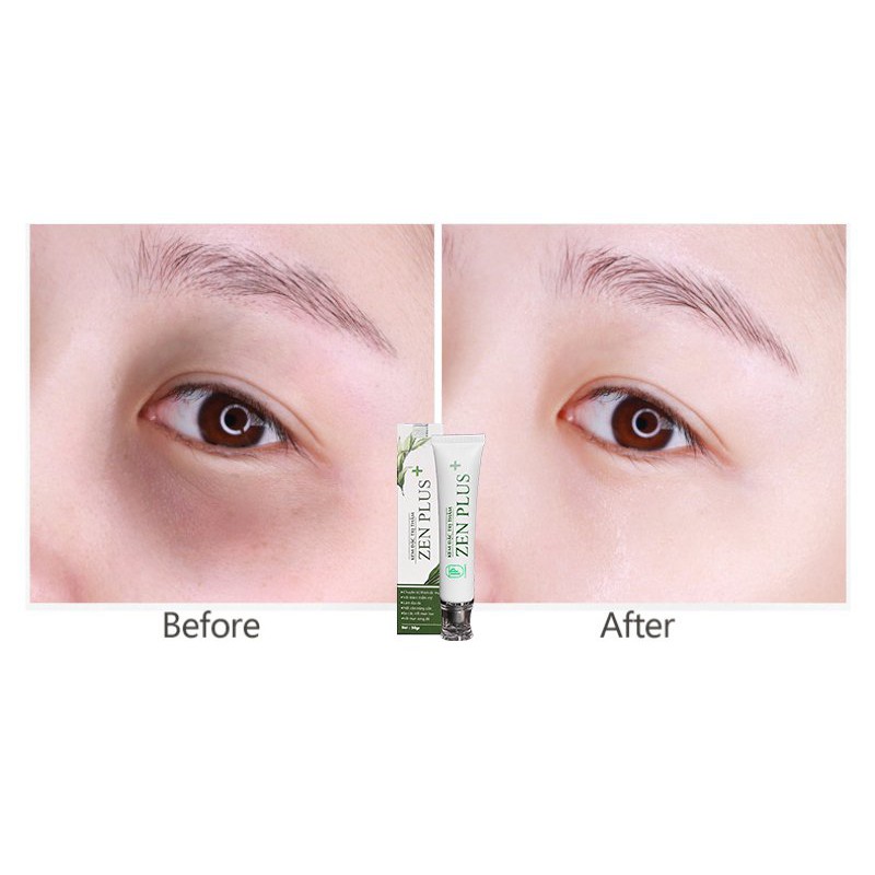 [Chính hãng] Kem thâm, sẹo Zenplus+ - Xua tan thâm, sẹo, nám an toàn - Mua 2 tặng 2 mặt nạ dưỡng da cao cấp | BigBuy360 - bigbuy360.vn