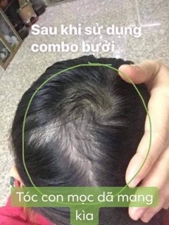 COMBO 3 CHAI TINH DẦU BƯỞI KÍCH MỌC TÓC ( tặng quà hấp dẫn )