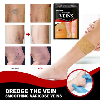 Miếng dán giảm giãn tĩnh mạch cho chân