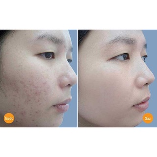 Gel Chấm Mụn SVR Sebiaclear Cicapeel 15ml