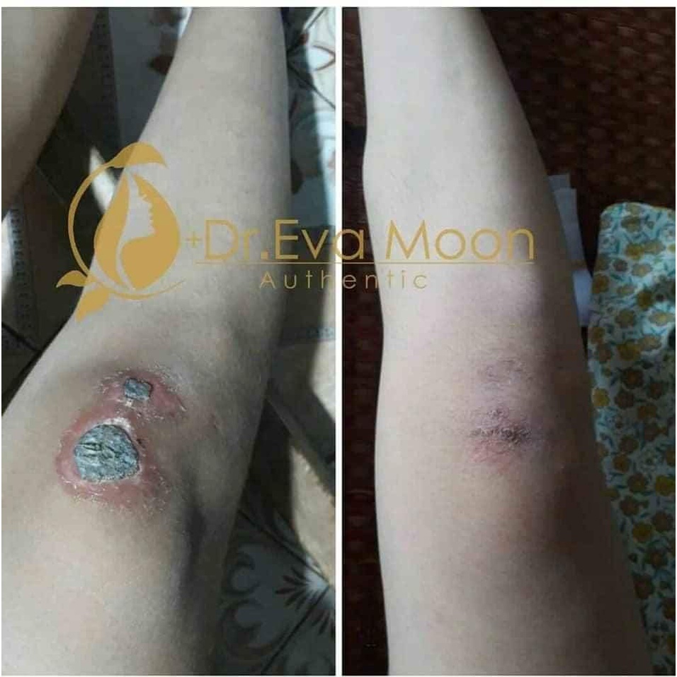 Kem Sẹo, Kem Sẹo Thâm, Rỗ Collagen Tươi Dr.EvaMoon CHÍNH HÃNG