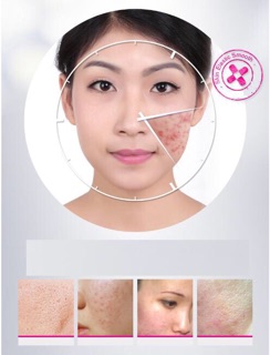 Kem Trị Mụn Bioaqua Pure Skin