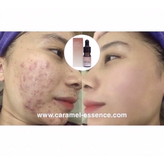 Serum caramel essence Nhật Bản(chính hãng )