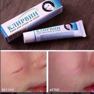 ❗️❗️❗️: vua tri sẹo rỗ lồi
klirvin nga
