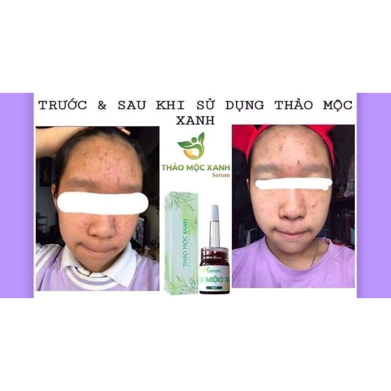 [ CHÍNH HÃNG]SERUM THẢO MỘC XANH | BigBuy360 - bigbuy360.vn