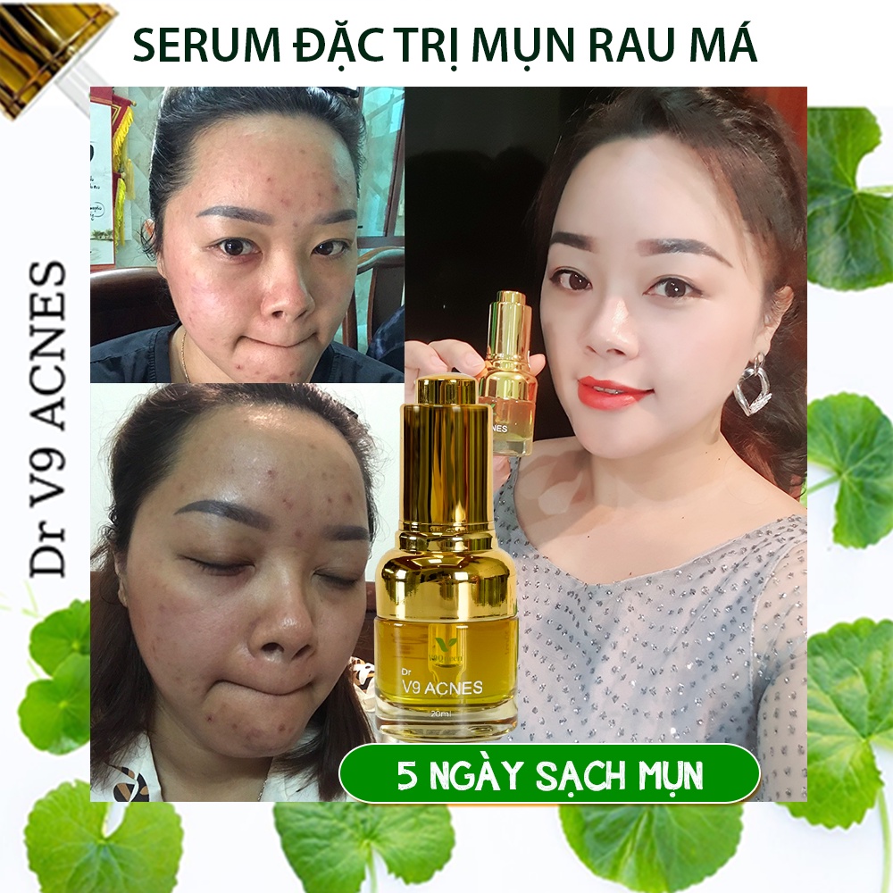 Serum Ngăn Ngừa Mụn V9Queen, Chiết Xuất Rau Má Giúp Dưỡng Trắng Da, Làm Mờ Thâm Mụn - V9 Acnes 20ml
