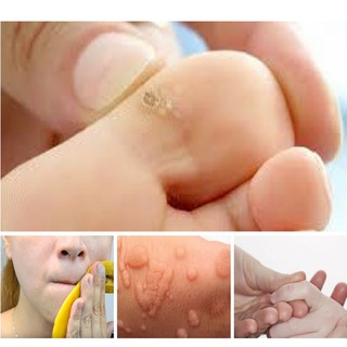 Miếng dán mụn mắt cá chân