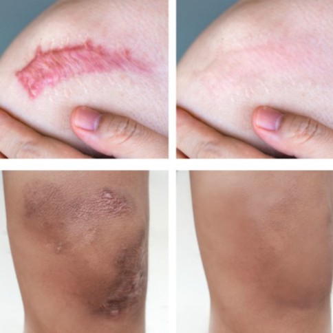 Kem Xóa Tan Sẹo Vibrant Glamour Treatment Gel EN