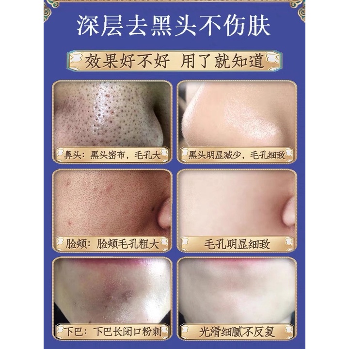 Gói mặt nạ than tre Bioaqua lột mụn đầu đen , mụn cám vùng mũi