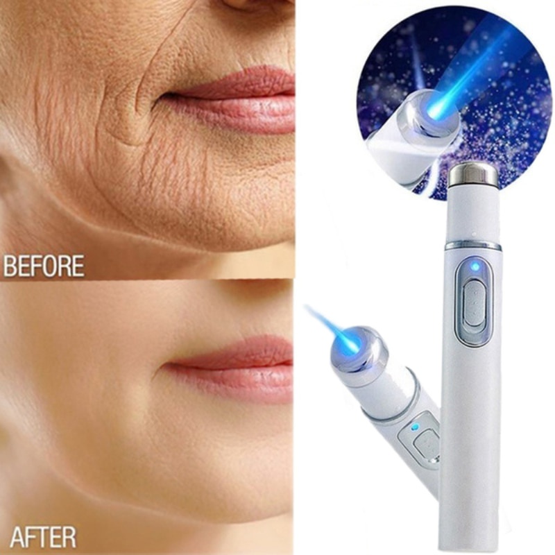 Xóa nếp nhăn mụn trứng cá  Laser Pen Loại bỏ đốm da Chống giãn tĩnh mạch nhện Eraser Điều trị di động Y tế Ánh sáng xanh Trị liệu