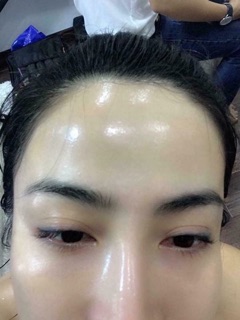      Placentex - tinh chất cá hồi dạng tiêm