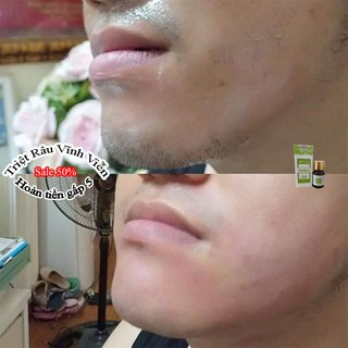 Kem Triệt Râu Vĩnh Viễn