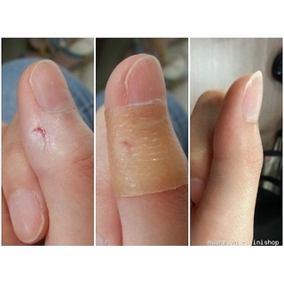 Miếng dán hút mụn