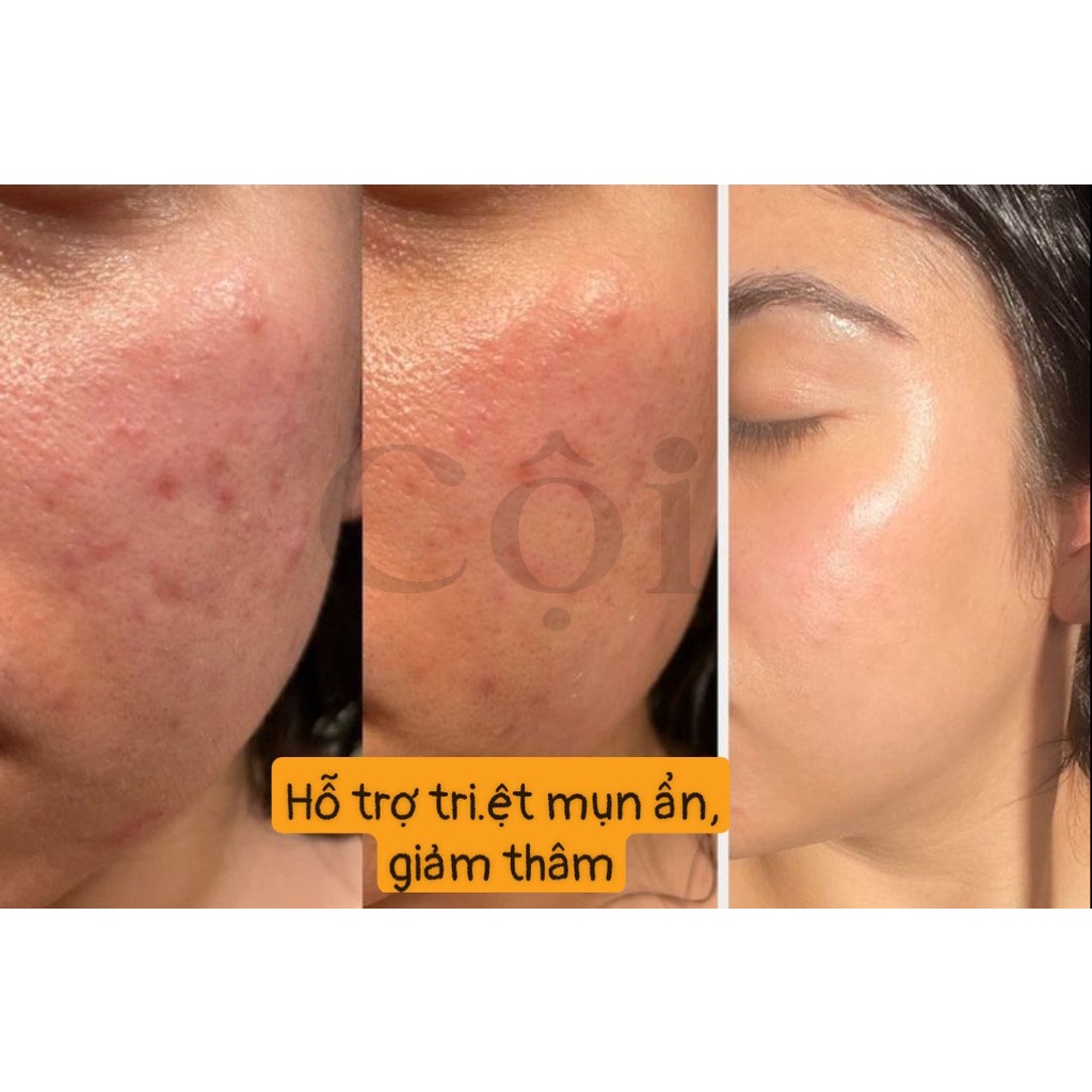 Peel da sinh học AHA 30% + BHA 2% - Peeling sinh học - Peel da tái tạo