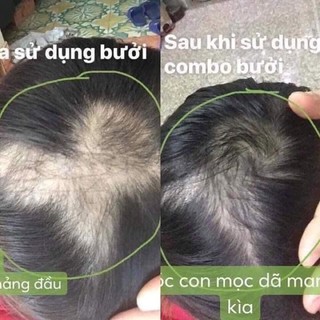 Combo chăm sóc tóc VIJULLY