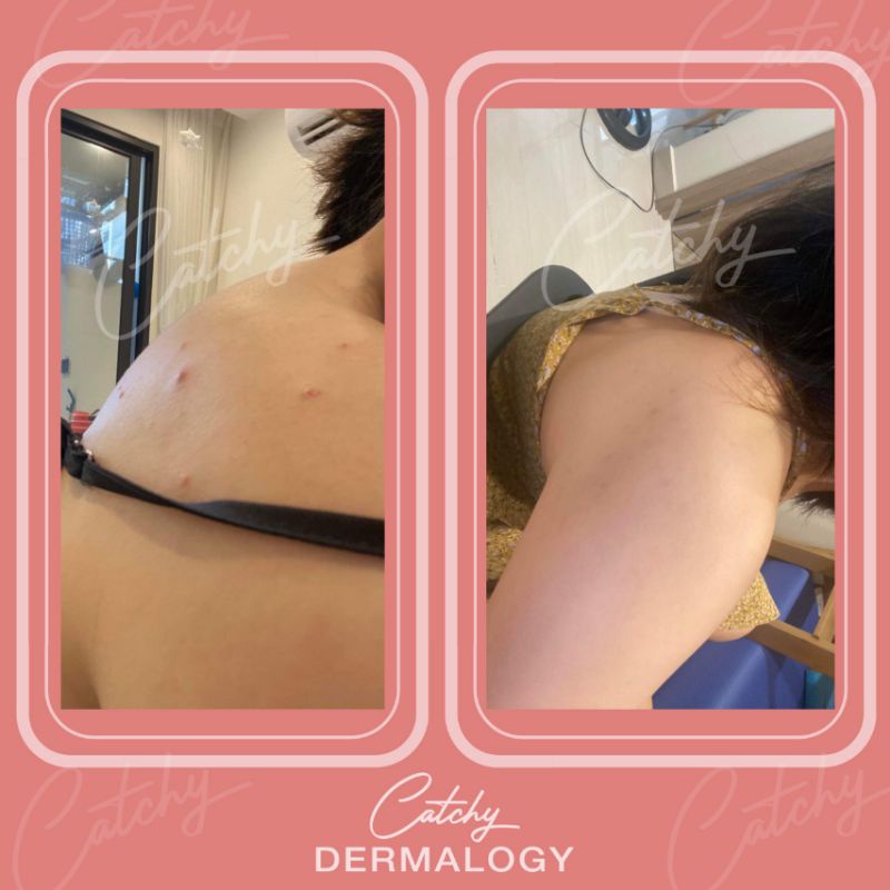 Dầu dưỡng da Body Oil 4%BHA + 2%AHA Catchy Dermalogy làm sáng da, tẩy tế bào chết hóa học