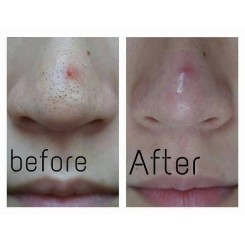 Miếng dán đẩy mụn đầu đen Goodbye BlackHead Ciracle