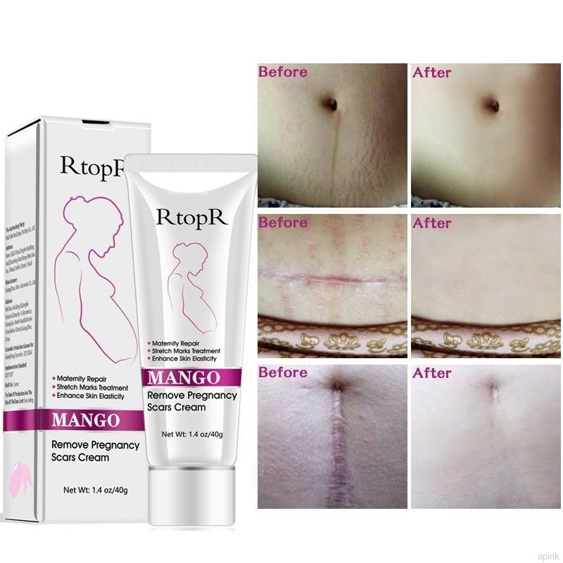 Kem cải thiện tình trạng rạn da sẹo rỗ dành cho mẹ bầu 40g