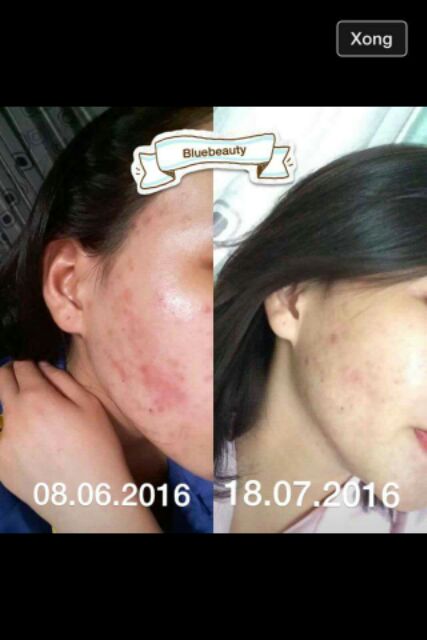 [Nội Địa Hàn] Bộ Loại Bỏ Mụn Ngừa Thâm Lành Sẹo ZYMOGEN Houttuynia Cordata Ferment Serum và Centella Cream | BigBuy360 - bigbuy360.vn