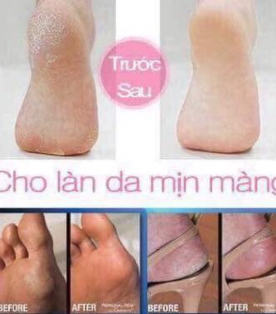 KEM CHUỐI TRỊ NỨT GÓT CHÂN THÁI LAN