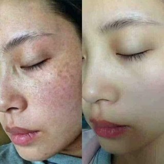 Transamin 500mg Trắng Da Trị Nám 100
