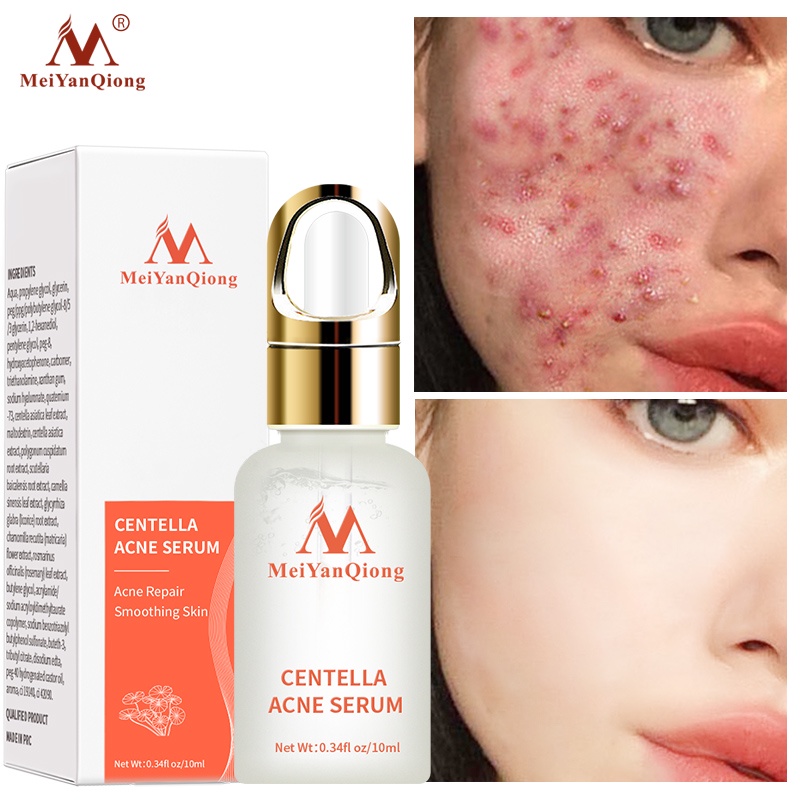 Serum hỗ trợ trị Mụn Trứng Tinh Chất Rau Má MeiYanQiong Kiềm Dầu Và Dưỡng Ẩm 10ml