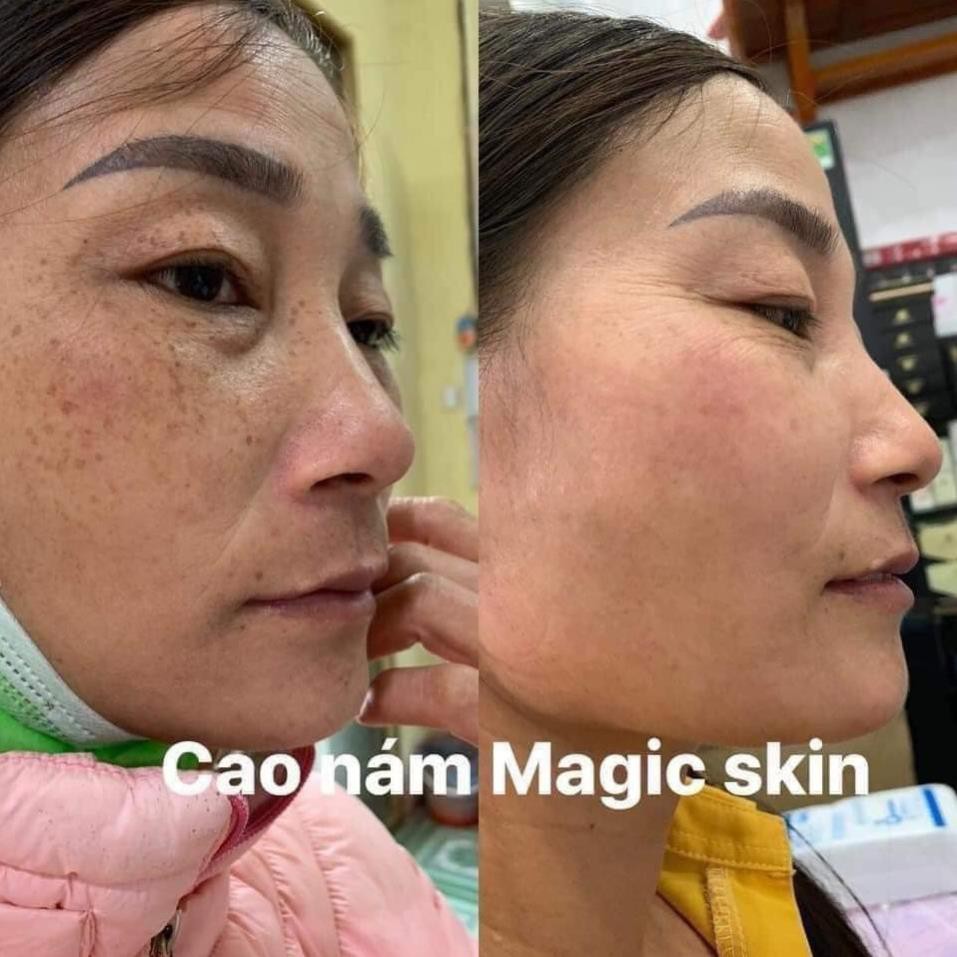 [CHÍNH HÃNG] Cao Nám Ngừa Nám Tàn Nhang Magic Skin ROYAL MELASMA PLUS 13g